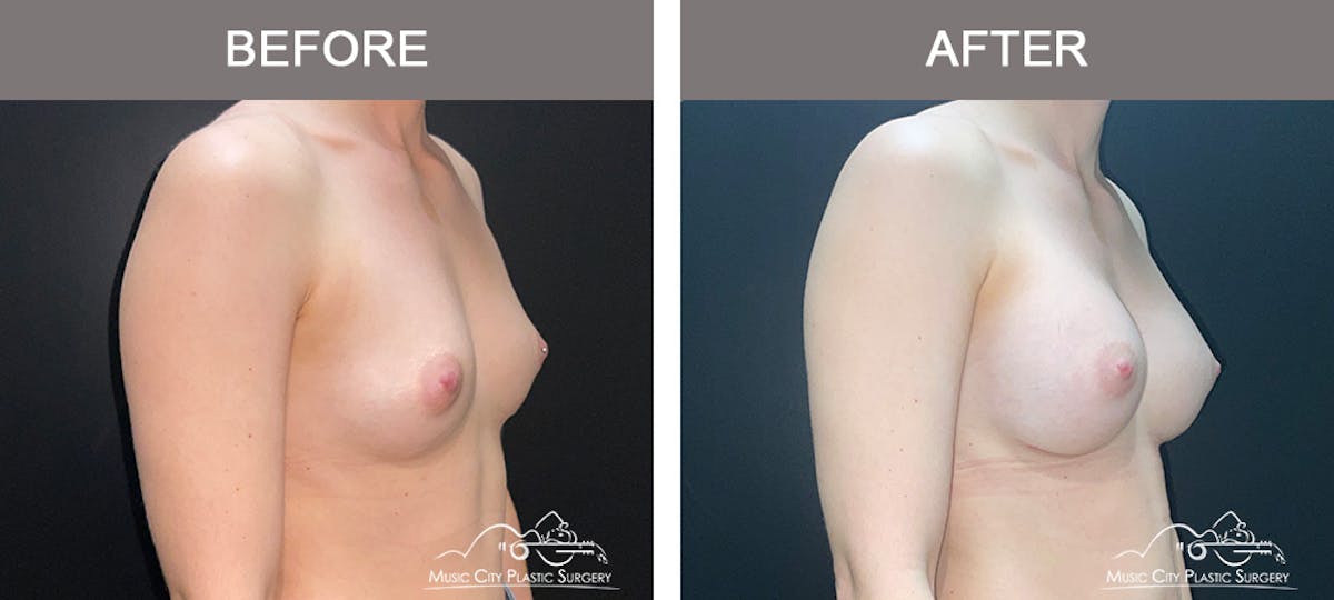 Breast Augmentation Before & After Gallery - Patient 185854 - Image 2