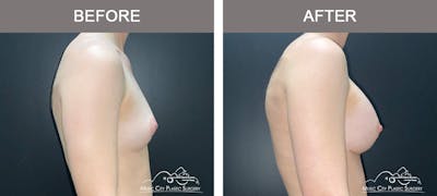 Breast Augmentation Before & After Gallery - Patient 185854 - Image 3