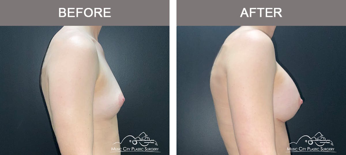 Breast Augmentation Before & After Gallery - Patient 185854 - Image 3