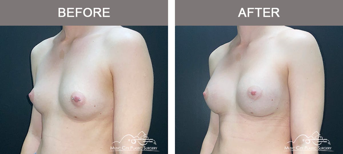 Breast Augmentation Before & After Gallery - Patient 185854 - Image 4
