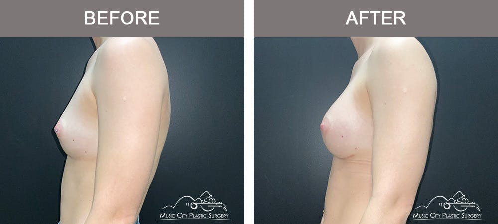 Breast Augmentation Before & After Gallery - Patient 185854 - Image 5