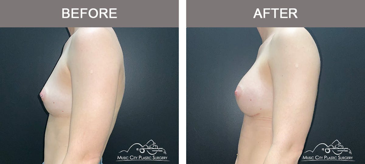Breast Augmentation Before & After Gallery - Patient 185854 - Image 5