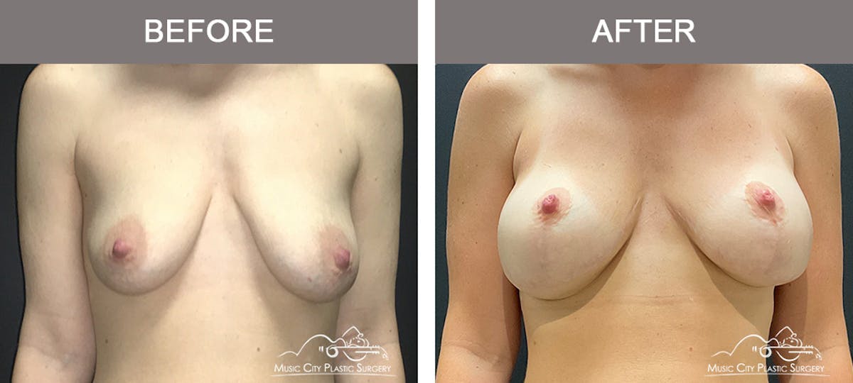 Breast Augmentation Before & After Gallery - Patient 102031 - Image 1