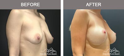 Breast Lift Before & After Gallery - Patient 227096 - Image 2