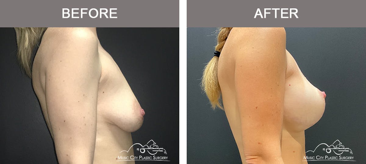 Breast Lift Before & After Gallery - Patient 227096 - Image 3