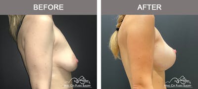 Breast Lift Before & After Gallery - Patient 227096 - Image 3