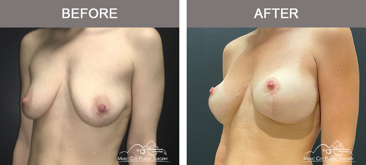 Breast Augmentation Before & After Gallery - Patient 102031 - Image 4