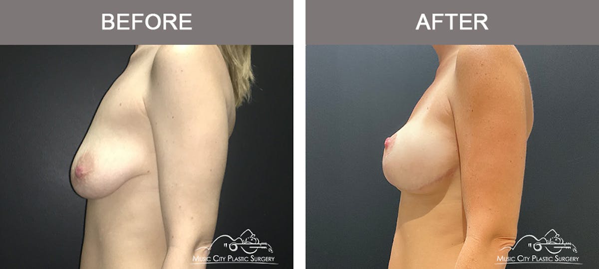 Breast Lift Before & After Gallery - Patient 227096 - Image 5