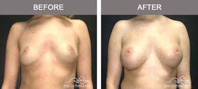 Breast Augmentation Before & After Gallery - Patient 420495 - Image 1