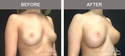 Breast Augmentation Before & After Gallery - Patient 420495 - Image 2