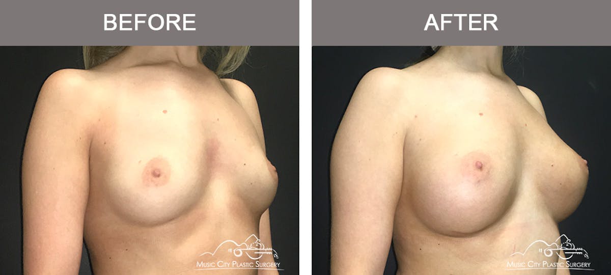 Breast Augmentation Before & After Gallery - Patient 420495 - Image 2