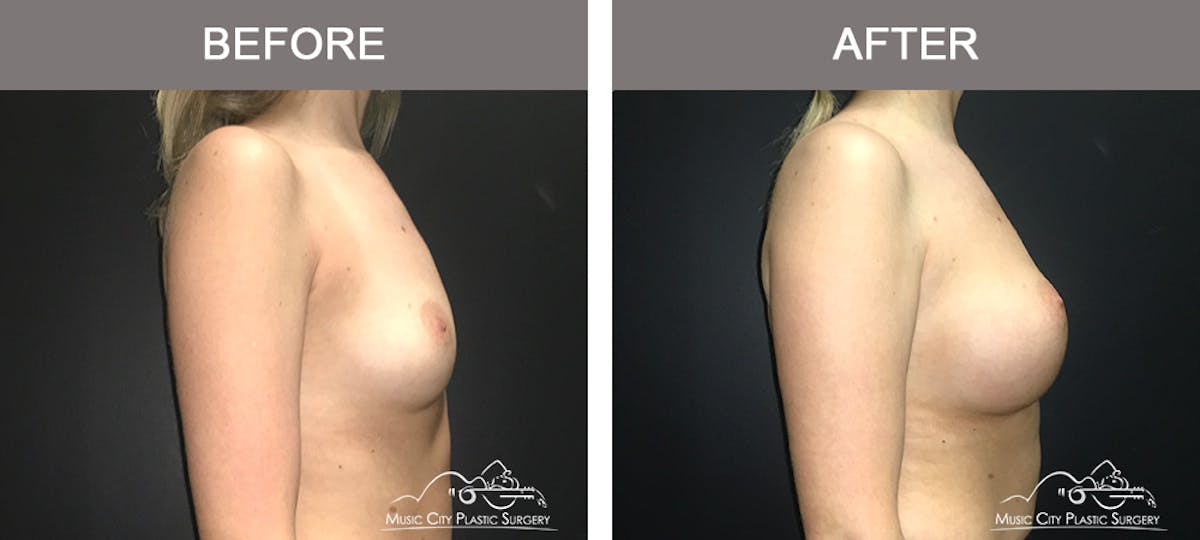 Breast Augmentation Before & After Gallery - Patient 420495 - Image 3