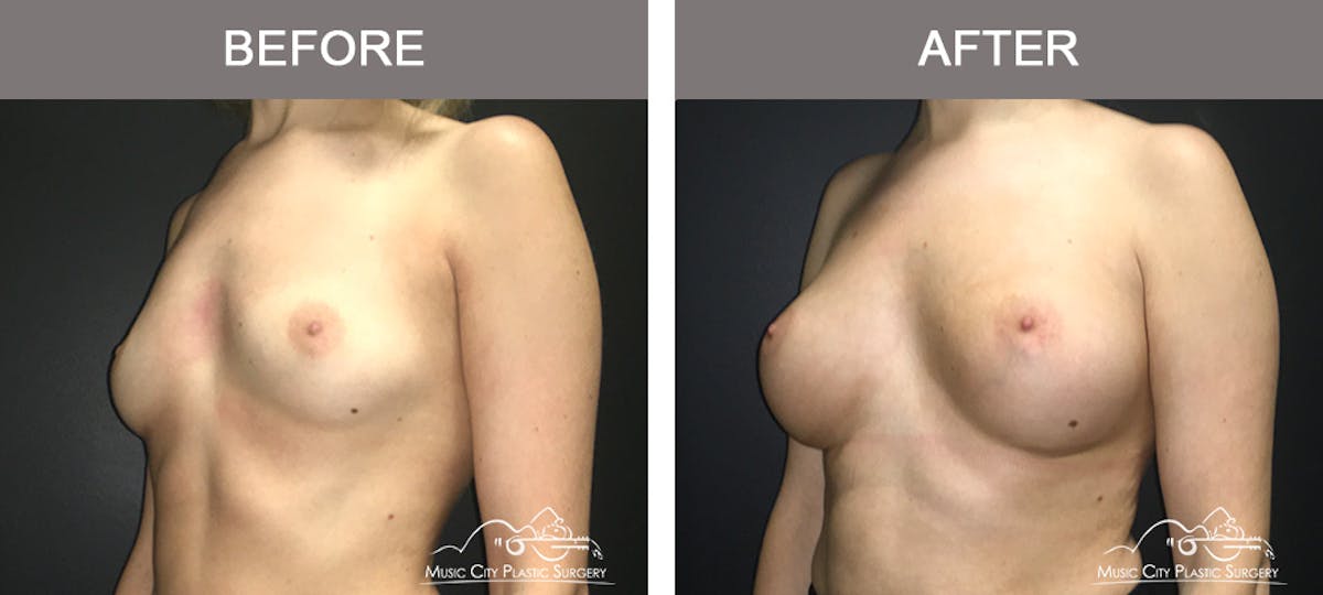 Breast Augmentation Before & After Gallery - Patient 420495 - Image 4