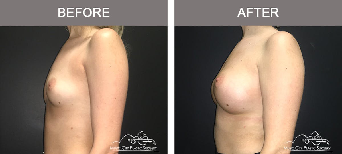 Breast Augmentation Before & After Gallery - Patient 420495 - Image 5