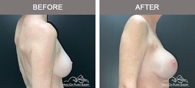 Implant Exchange Before & After Gallery - Patient 418366 - Image 3