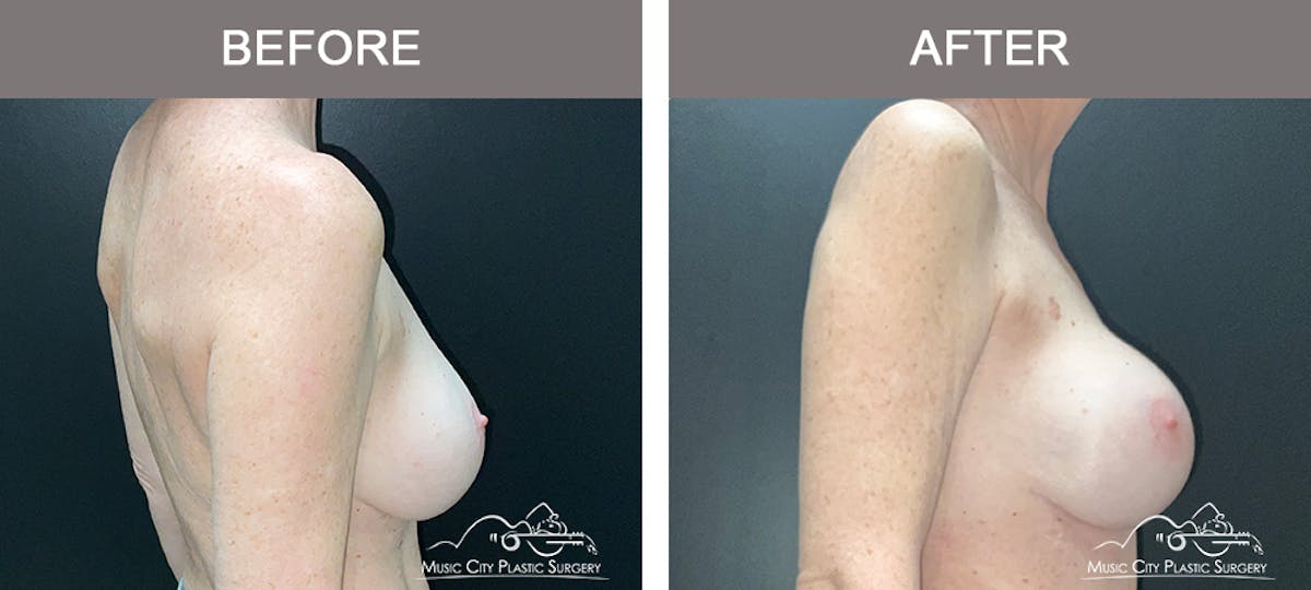 Implant Exchange Before & After Gallery - Patient 418366 - Image 3