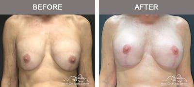 Breast Lift Before & After Gallery - Patient 539081 - Image 1