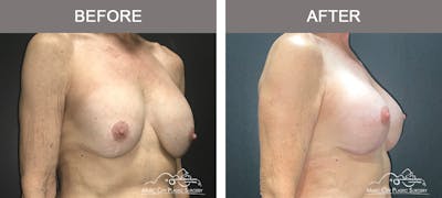 Breast Lift Before & After Gallery - Patient 539081 - Image 2