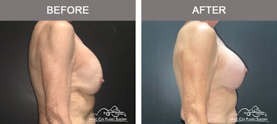 Breast Lift Before & After Gallery - Patient 539081 - Image 3