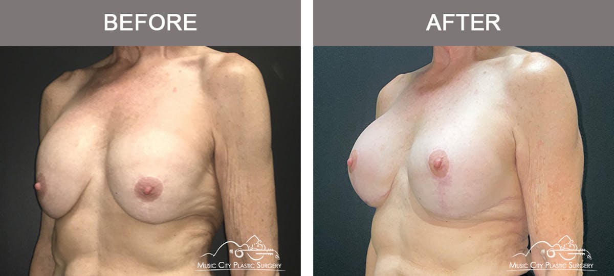 Breast Lift Before & After Gallery - Patient 539081 - Image 4
