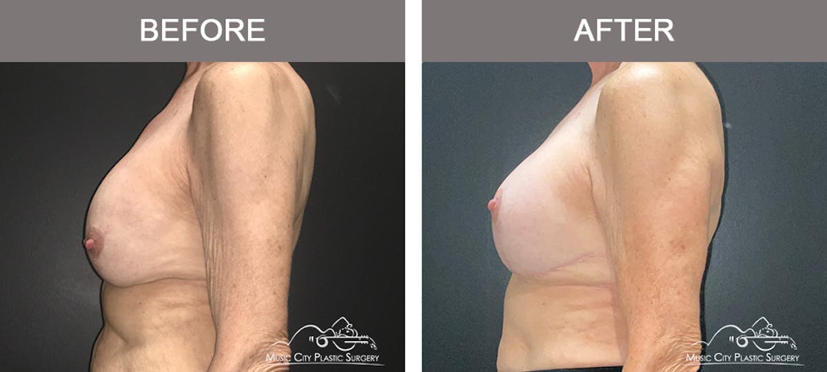 Breast Lift Before & After Gallery - Patient 539081 - Image 5