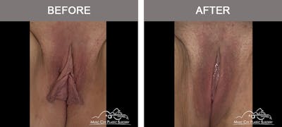 Labiaplasty Before & After Gallery - Patient 910079 - Image 1
