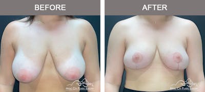 Breast Lift Before & After Gallery - Patient 362200 - Image 1