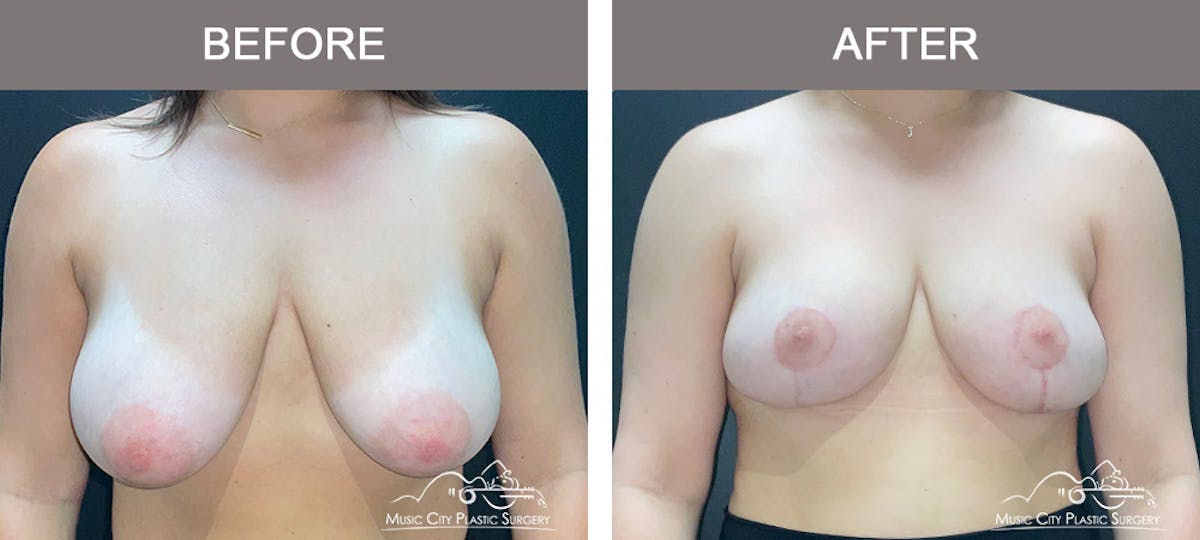 Breast Lift Before & After Gallery - Patient 362200 - Image 1