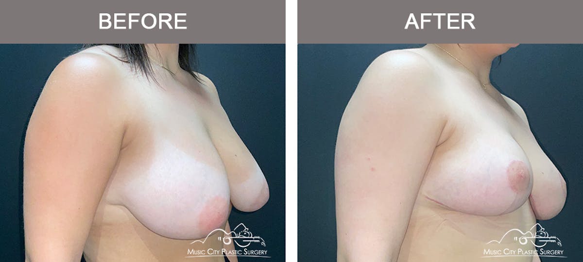 Breast Reduction Before & After Gallery - Patient 393898 - Image 2