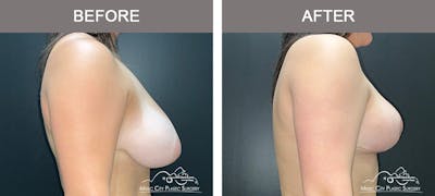 Breast Reduction Before & After Gallery - Patient 393898 - Image 3