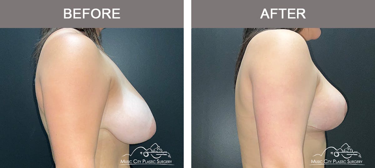 Breast Lift Before & After Gallery - Patient 362200 - Image 3