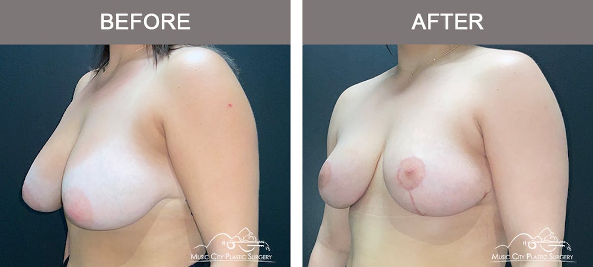 Breast Lift Before & After Gallery - Patient 362200 - Image 4