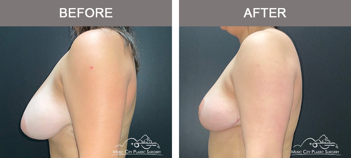 Breast Lift Before & After Gallery - Patient 362200 - Image 5