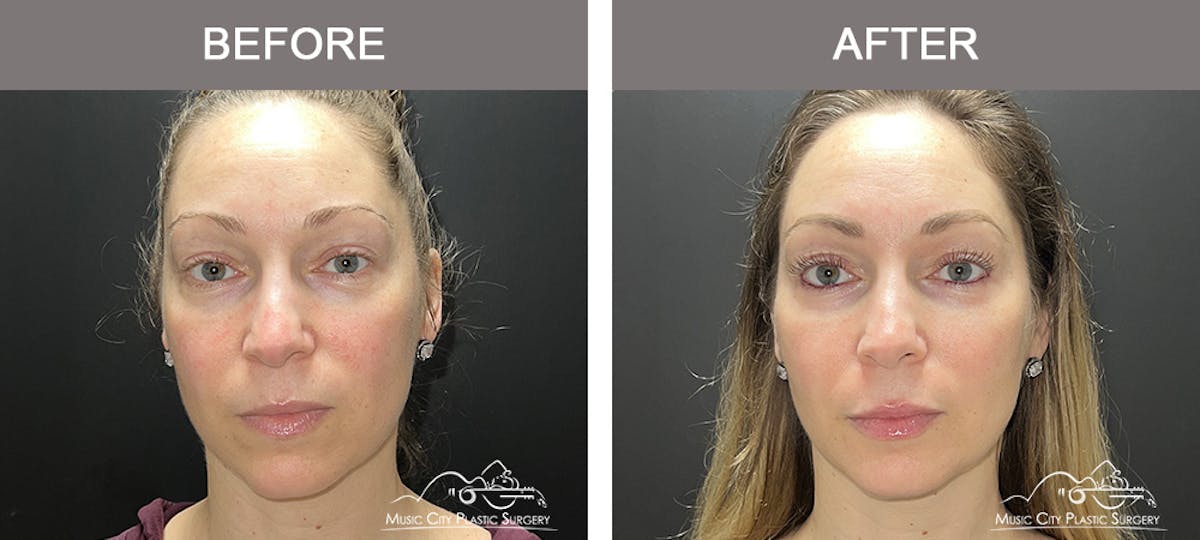 Dermal Fillers Before & After Gallery - Patient 100091 - Image 1