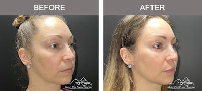 Dermal Fillers Before & After Gallery - Patient 100091 - Image 2