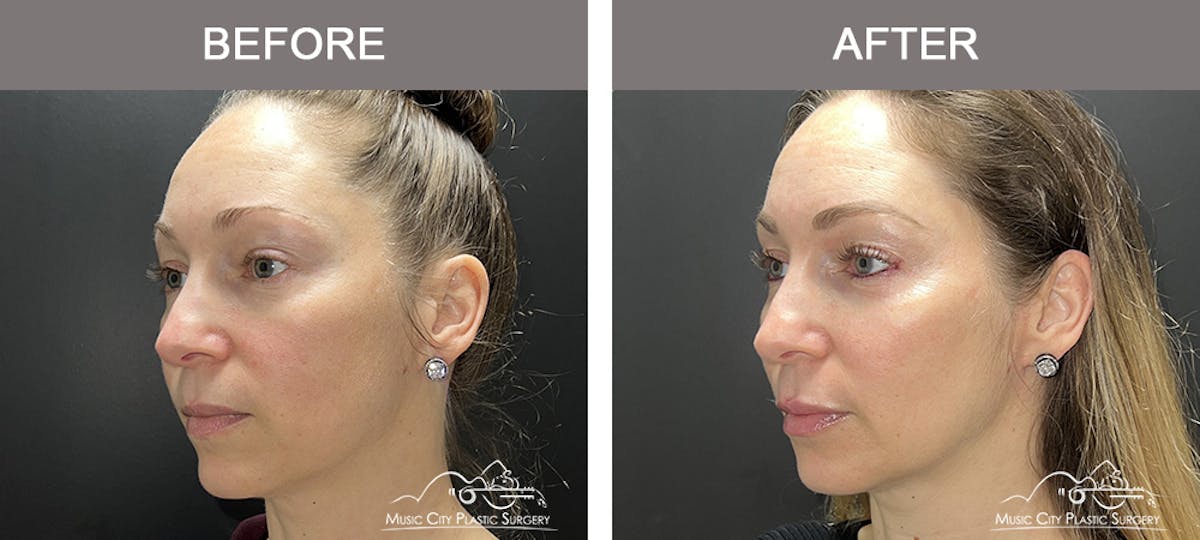 Dermal Fillers Before & After Gallery - Patient 100091 - Image 3
