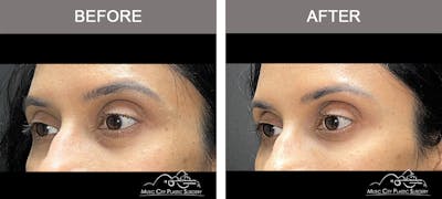 Dermal Fillers Before & After Gallery - Patient 182355 - Image 2