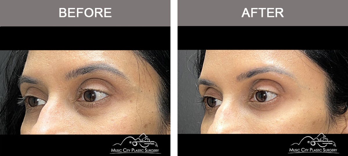 Dermal Fillers Before & After Gallery - Patient 182355 - Image 2