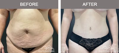 Abdominoplasty Before & After Gallery - Patient 281490 - Image 1