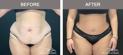 Abdominoplasty Before & After Gallery - Patient 101838 - Image 1