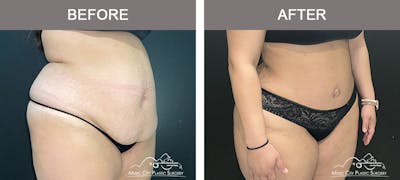 Abdominoplasty Before & After Gallery - Patient 101838 - Image 2