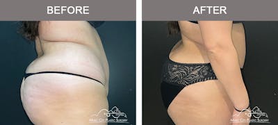 Abdominoplasty Before & After Gallery - Patient 101838 - Image 3