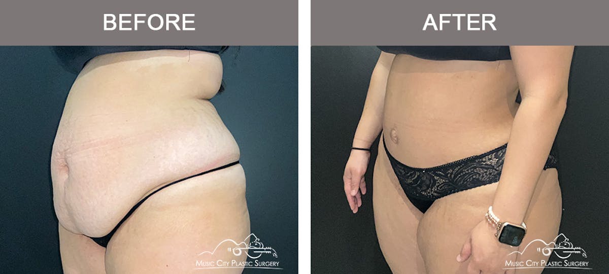Abdominoplasty Before & After Gallery - Patient 101838 - Image 4