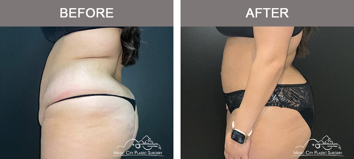Abdominoplasty Before & After Gallery - Patient 101838 - Image 5