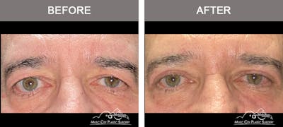 Blepharoplasty Before & After Gallery - Patient 339474 - Image 1