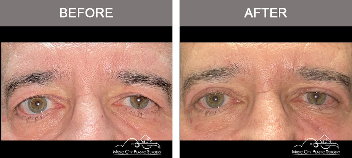 Blepharoplasty Before & After Gallery - Patient 339474 - Image 1