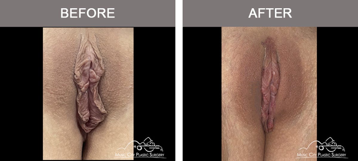 Labiaplasty Before & After Gallery - Patient 409802 - Image 1