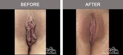 Labiaplasty Before & After Gallery - Patient 409802 - Image 1
