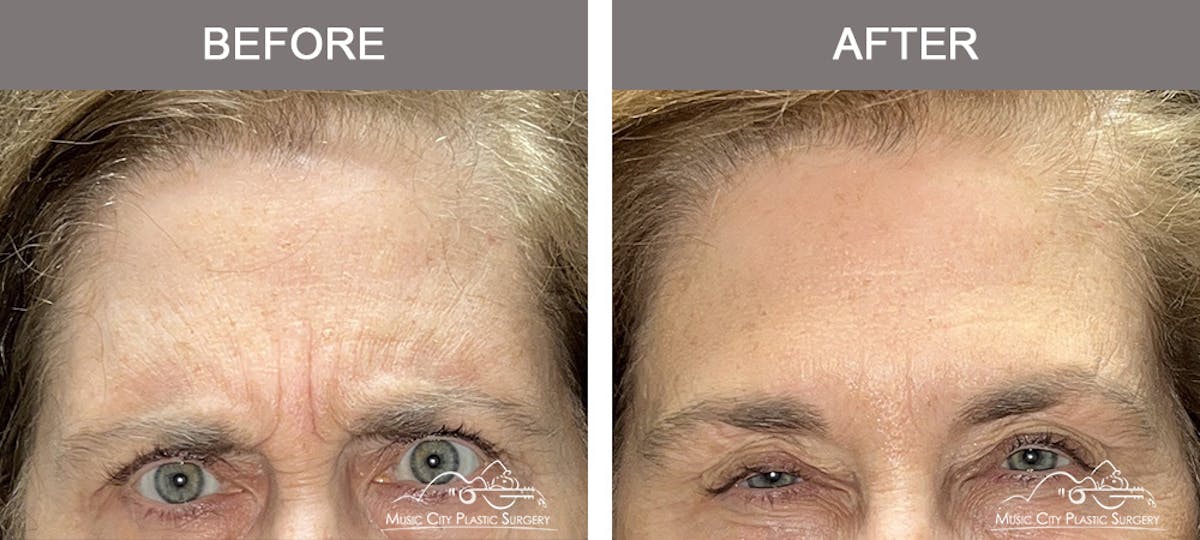 Dysport or Botox Before & After Gallery - Patient 416055 - Image 1