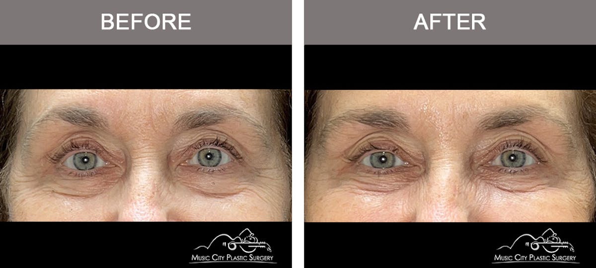 Dysport or Botox Before & After Gallery - Patient 463231 - Image 2